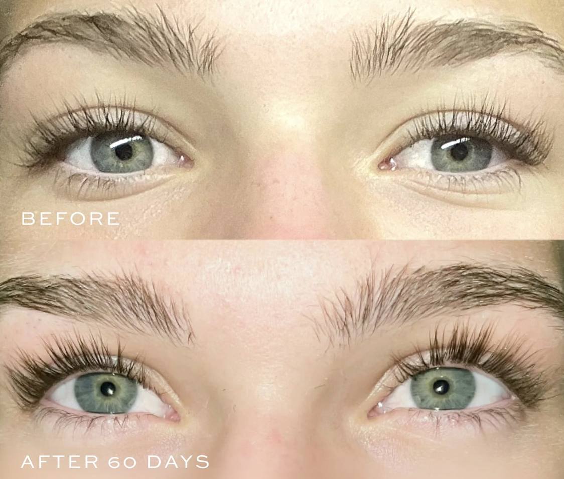 Both eyes before and after sixty days, a fuller lash line after