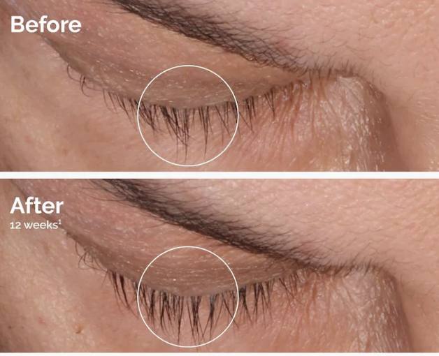 A single eye before and after twelve weeks, lashes circled in both frames
